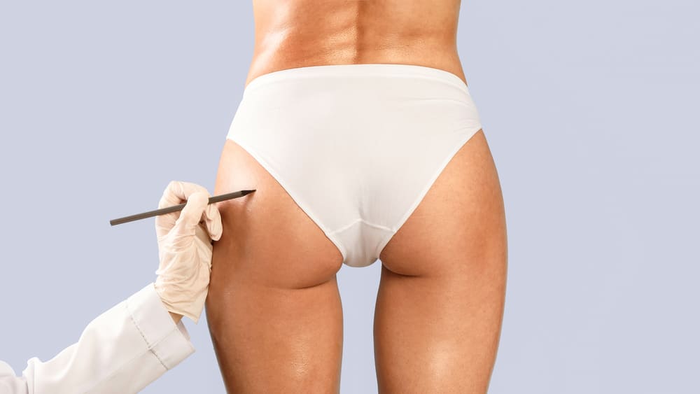 pexia glútea en Colombia