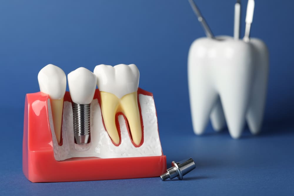 implantes dentales