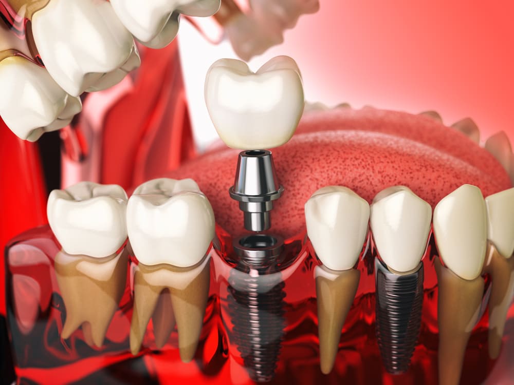 implantes dentales