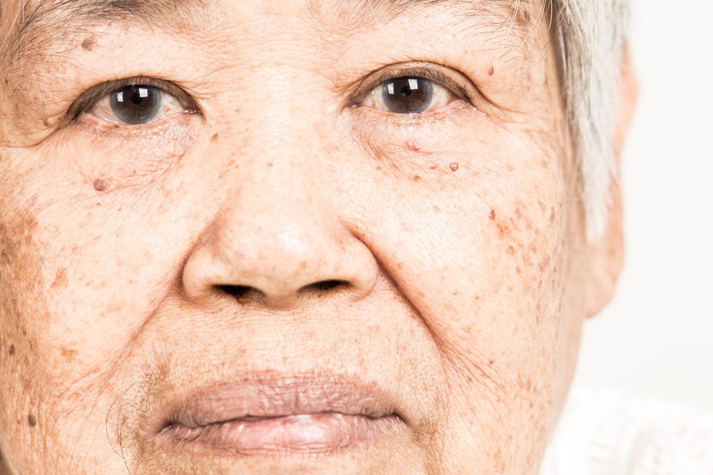 Lifting facial