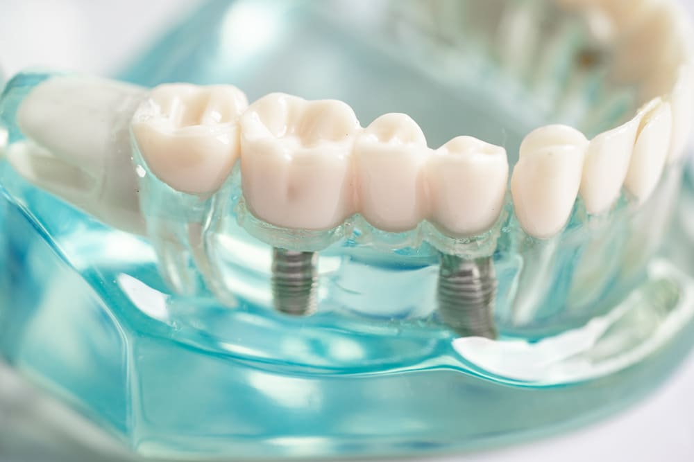 implante dental en Panamá