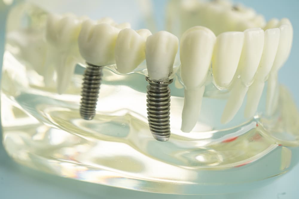 implante dental en Panamá