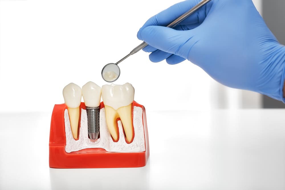implante dental en Panamá
