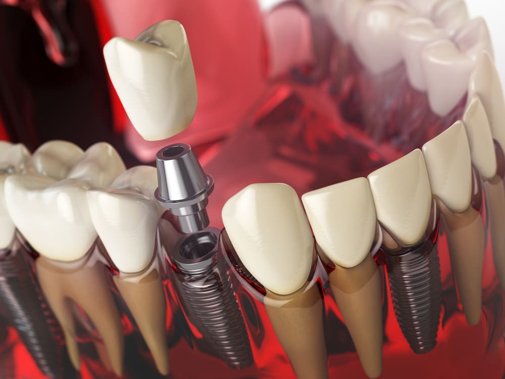 implantes dentales en Costa del Este, Panamá