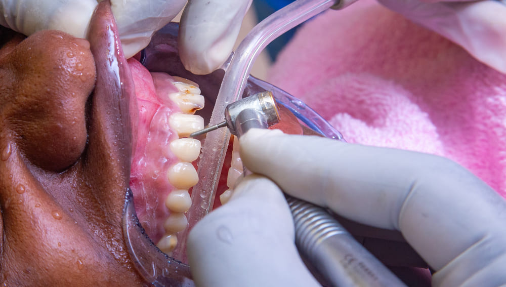 limpieza dental