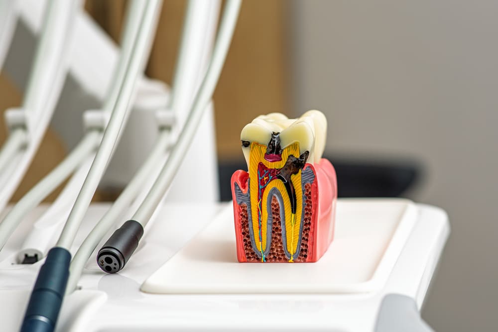 Endodoncia en Panamá: qué es, cuándo se necesita y cómo se realiza