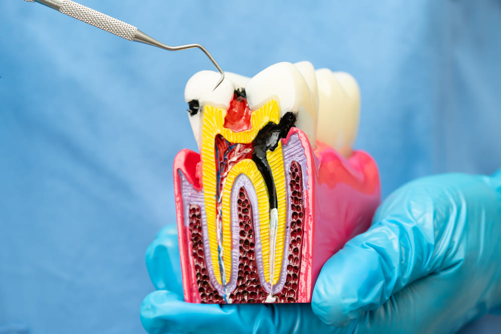 Endodoncia en Panamá: cómo identificar cuándo se necesita