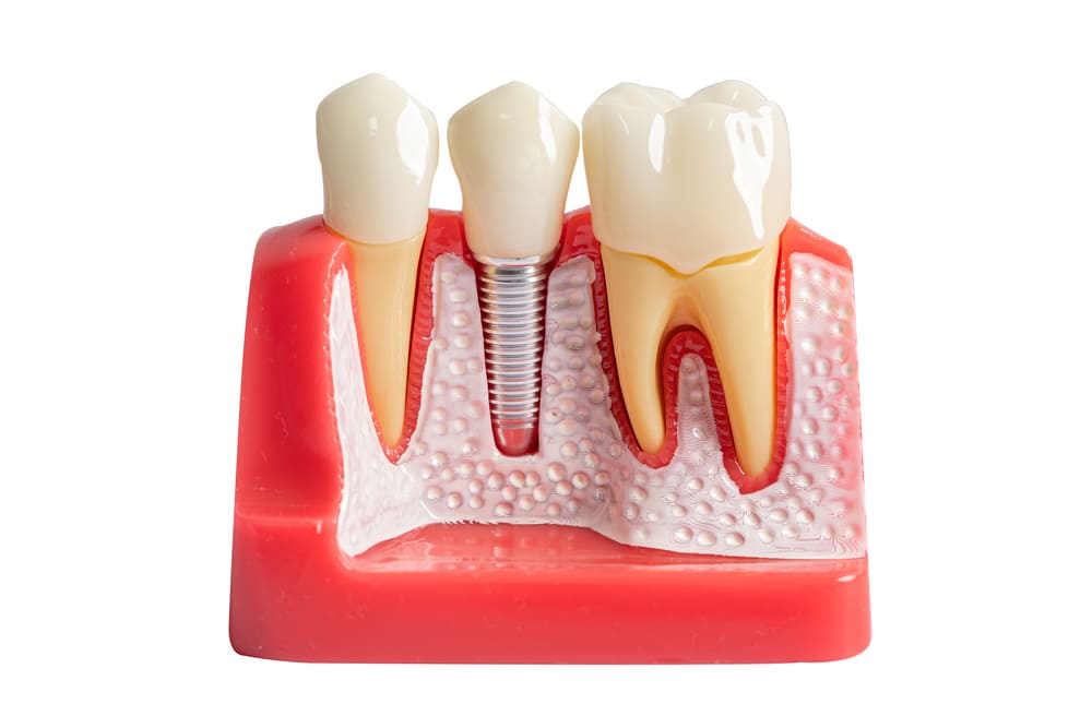 Rehabilitación oral completa en Panamá: restauración de la mordida y salud dental