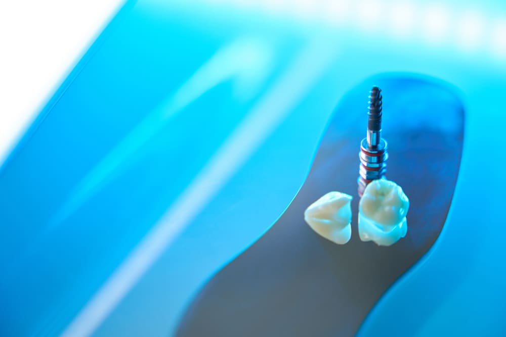 Función y estética dental después de una rehabilitación oral completa en Panamá