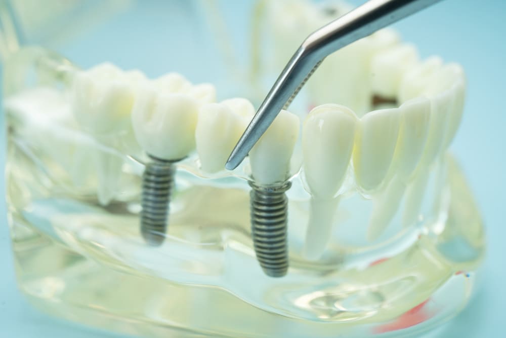 rehabilitación oral completa